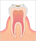 虫歯の進行状態C1（エナメル質う蝕）