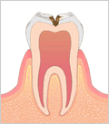 虫歯の進行状態C2（象牙質う蝕）
