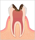虫歯の進行状態C3（神経まで達したう蝕）