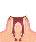 虫歯の進行状態C4（残根状態）